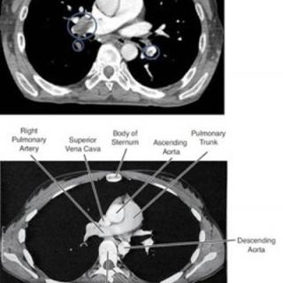 CT scan of pulmonary embolism