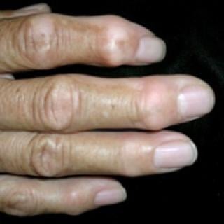 USMLE example of hand pain stiffness